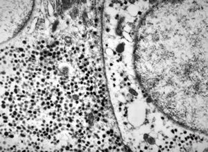 F, 44y. | carcinoid